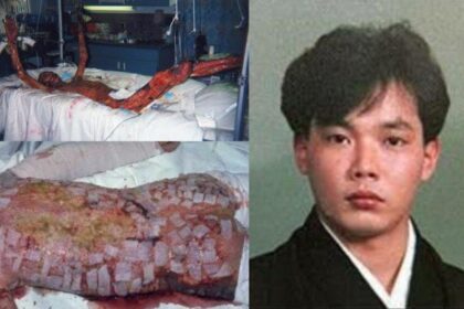 Radiation Poisoning: The Nuclear Accident of hisashi ouchi photos