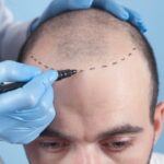 Why Sapphire Hair Transplant is Becoming the Go-To Choice for Hair Restoration