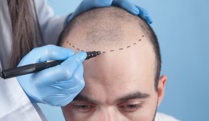 Why Sapphire Hair Transplant is Becoming the Go-To Choice for Hair Restoration