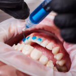 At-Home Teeth Whitening: Is Teeth Bleaching Gel Right for You?