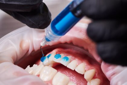 At-Home Teeth Whitening: Is Teeth Bleaching Gel Right for You?