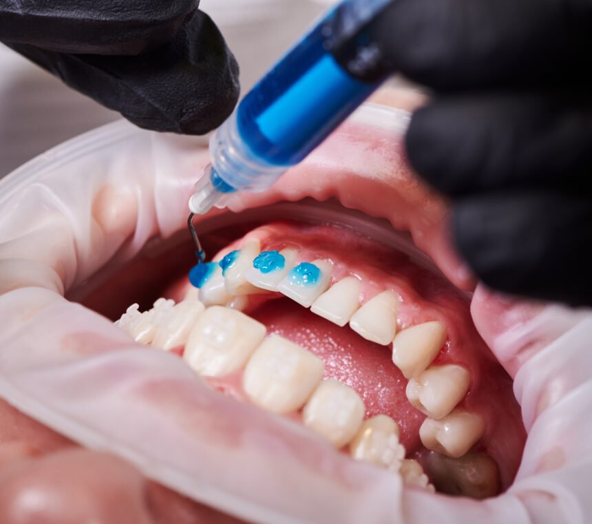 At-Home Teeth Whitening: Is Teeth Bleaching Gel Right for You?