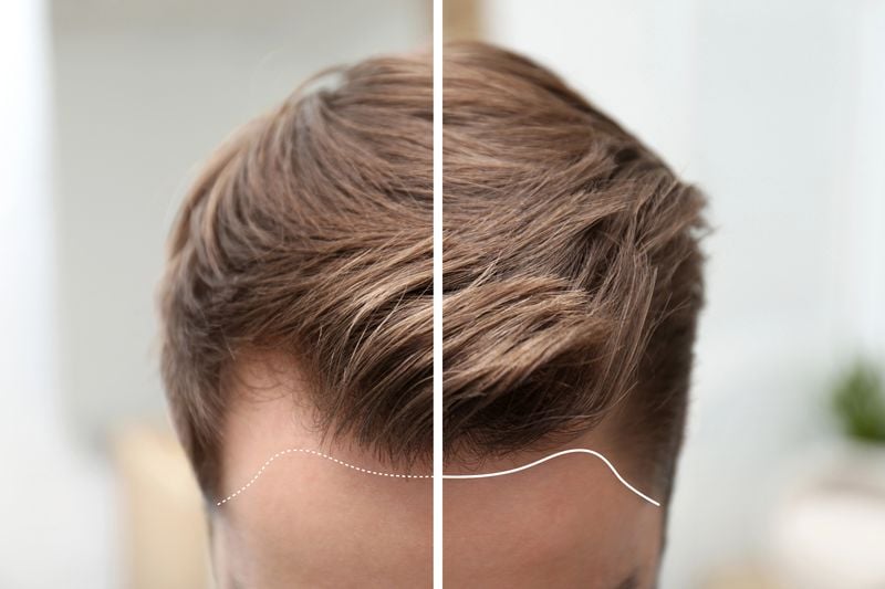 Why Turkey Is the Best Place to Get Hair Transplants: Prices, Clinics, and Outcomes