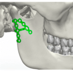 Maxillofacial Locking Plates: Revolutionary Advancements in Facial Reconstruction