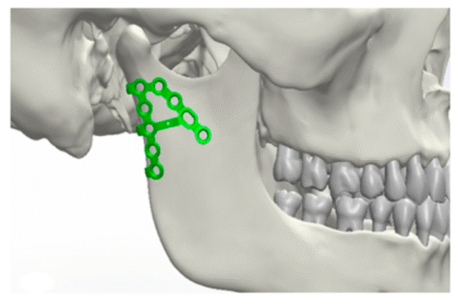 Maxillofacial Locking Plates: Revolutionary Advancements in Facial Reconstruction