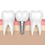 Discover the Best Way to Replace a Single Lost Tooth
