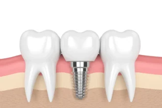 Discover the Best Way to Replace a Single Lost Tooth