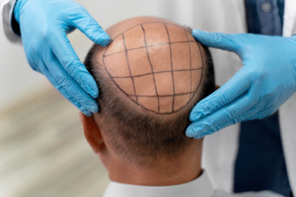 Hair Transplant