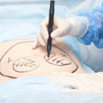 Cosmetic Surgery in Turkey