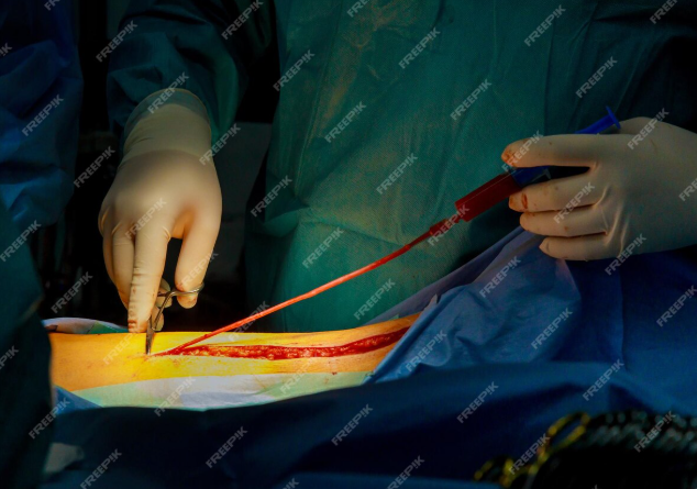 TM Flow System Helps Choose Right Amniotic Wound Graft