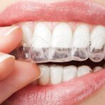 Invisalign