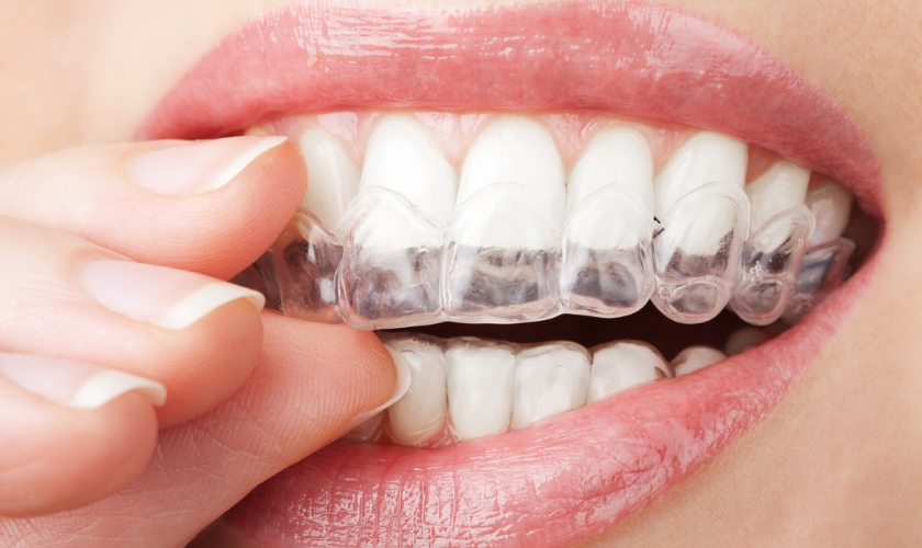Invisalign