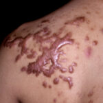 Keloids