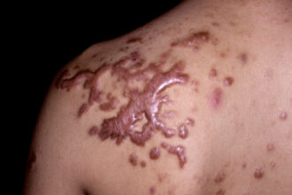 Keloids