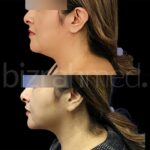 Double Chin Removal in Dubai