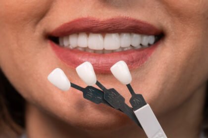 Avoid Veneer Tech: Why You Should See a Cosmetic Dentist Instead