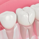 Cracked tooth? How a tooth filling can prevent bigger problems