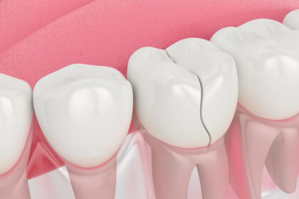 Cracked tooth? How a tooth filling can prevent bigger problems