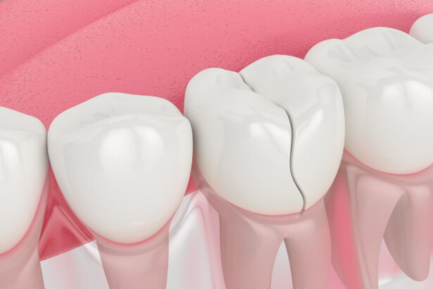 Cracked tooth? How a tooth filling can prevent bigger problems
