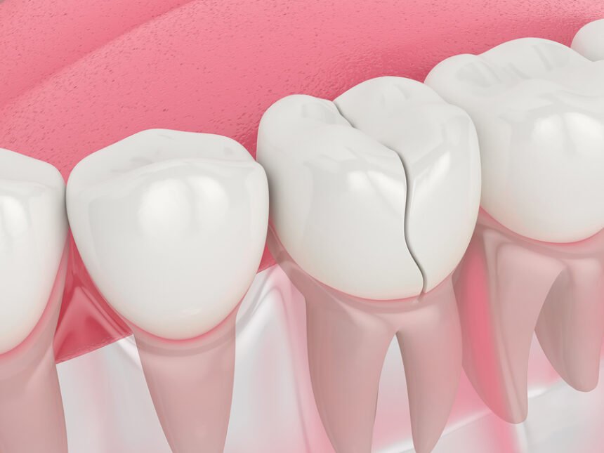 Cracked tooth? How a tooth filling can prevent bigger problems