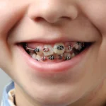 How Braces Work: The Science Behind Your Smile