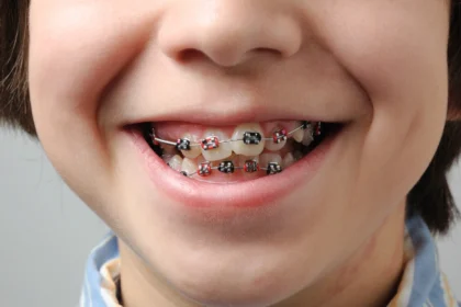 How Braces Work: The Science Behind Your Smile