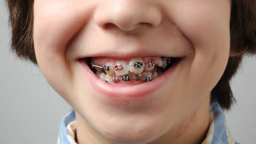 How Braces Work: The Science Behind Your Smile