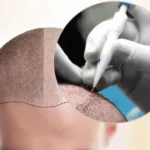 Hair Implant Istanbu