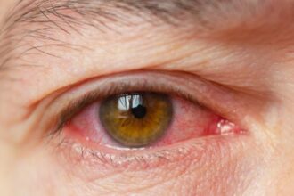 Everything You Need to Know bělmo