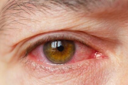 Everything You Need to Know bělmo