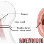 Adenoidid: Understanding Causes and Treatments