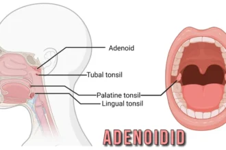 Adenoidid: Understanding Causes and Treatments