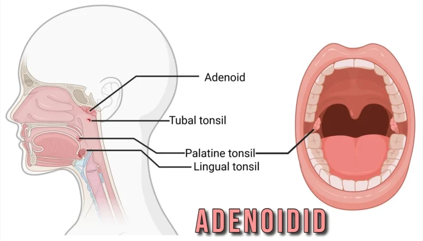 Adenoidid: Understanding Causes and Treatments