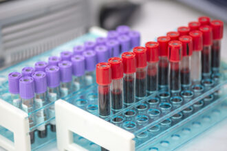 Serum Separator Tube: The Science Behind Accurate Blood Testing