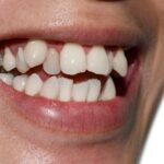 Crowded Teeth: How They Impact Your Oral Health and Smile