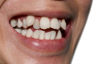 Crowded Teeth: How They Impact Your Oral Health and Smile
