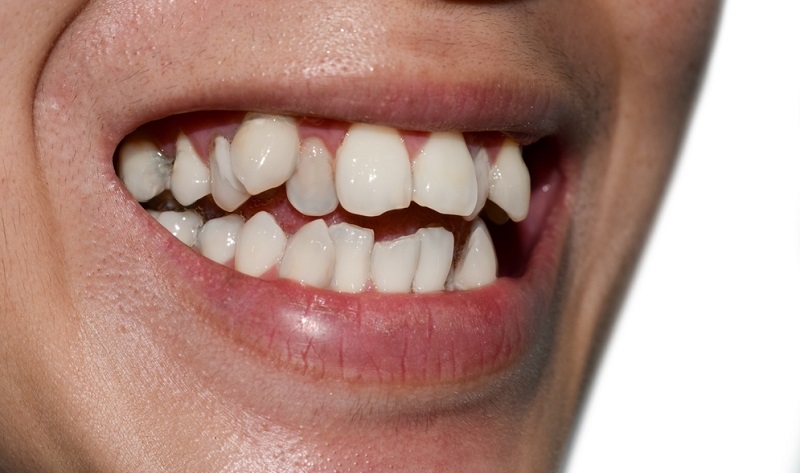 Crowded Teeth: How They Impact Your Oral Health and Smile
