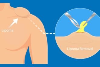 Lipoma