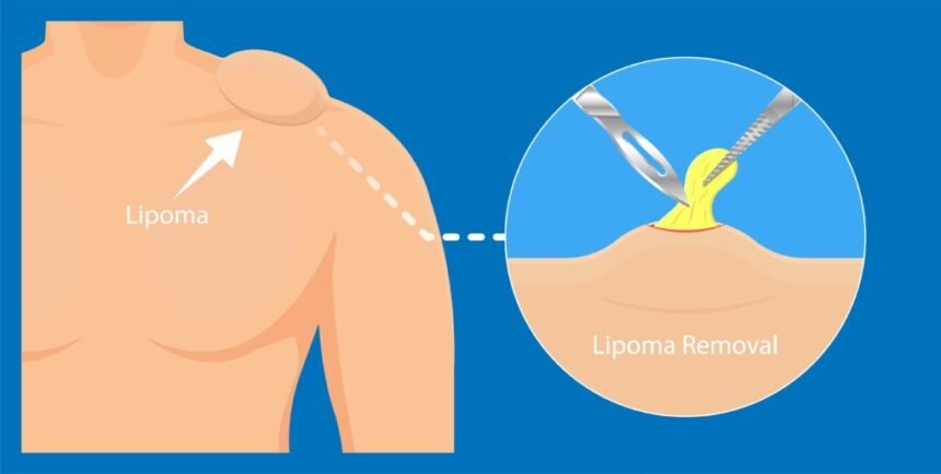 Lipoma