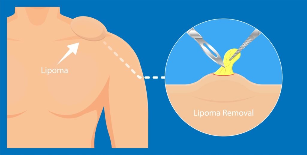 Lipoma