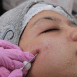 Microneedling