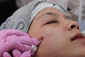Microneedling