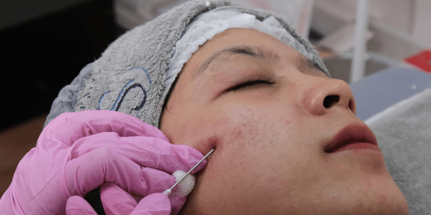 Microneedling