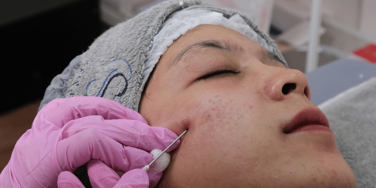 Microneedling