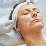 How Minimally Invasive Precision in Facelift Surgery in London (UK) Is Rewriting the Rules for Natural Results