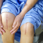 Top 5 Mistakes After Knee Replacement​