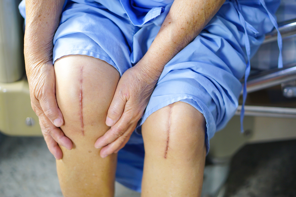 Top 5 Mistakes After Knee Replacement​