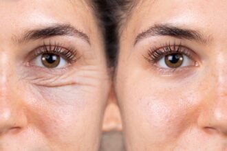 Does Medicare Cover Eyelid Surgery? Eligibility Guide