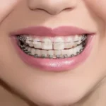 Ceramic Orthodontic Braces Revolutionize Smiles with Invisible Magic