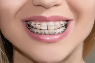 Ceramic Orthodontic Braces Revolutionize Smiles with Invisible Magic